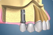 Implant to Tooth Bridge with Liner